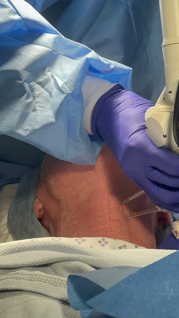CO2 laser resurfacing in progress, with the fractional laser pattern visible on the skin