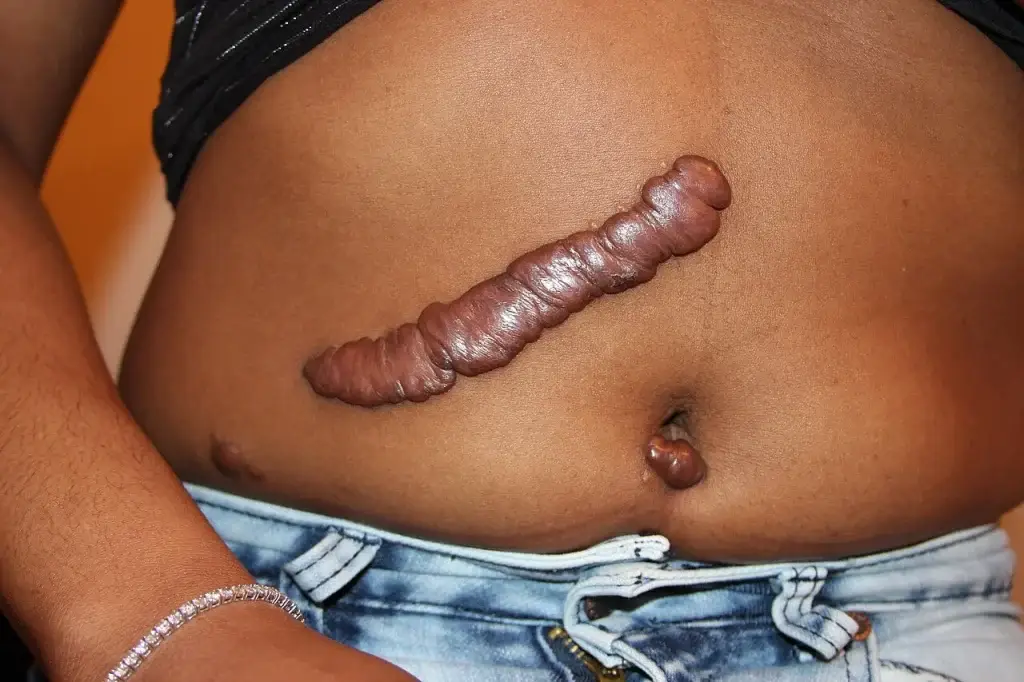 A raised keloid scar on the abdomen