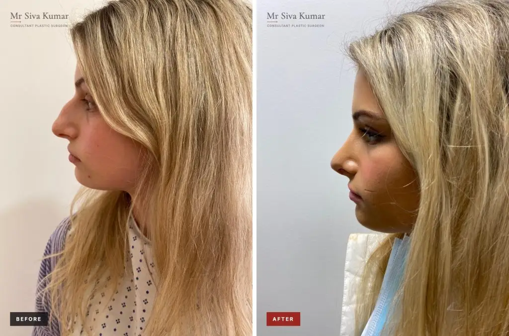 Rhinoplasty before and after: side profile showing a smoother nasal bridge, case 1