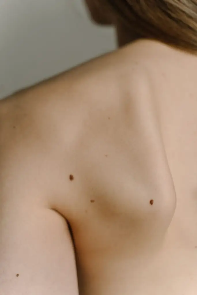 Close-up of skin and moles on the back