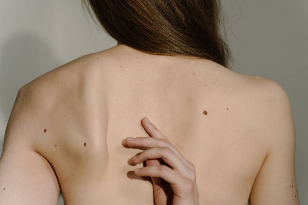 Moles on the skin of the back