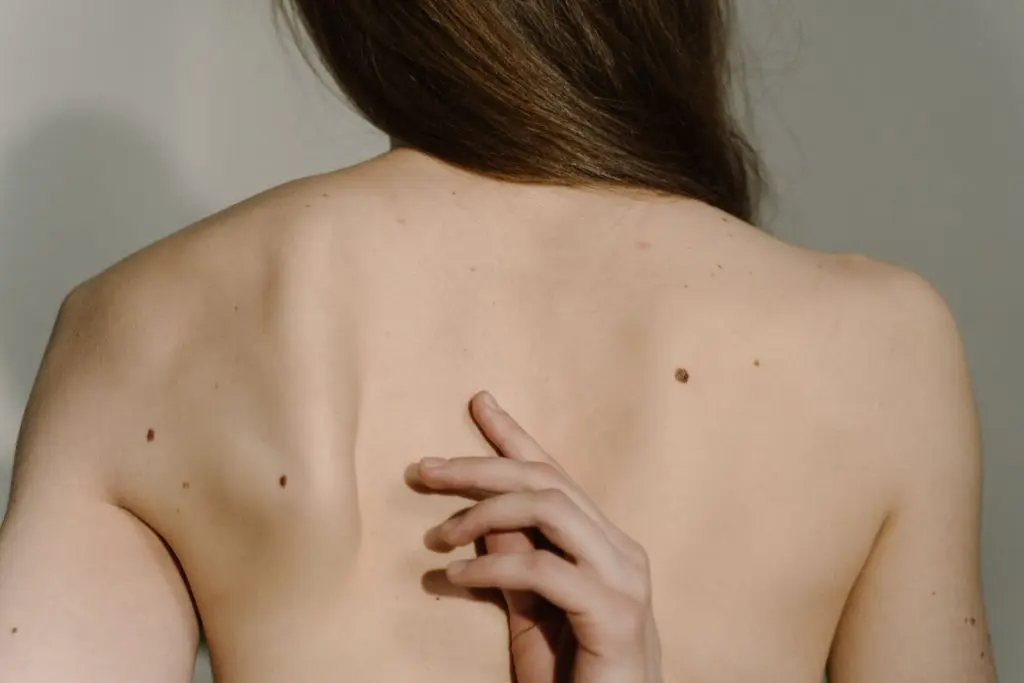 Moles on the skin of the back