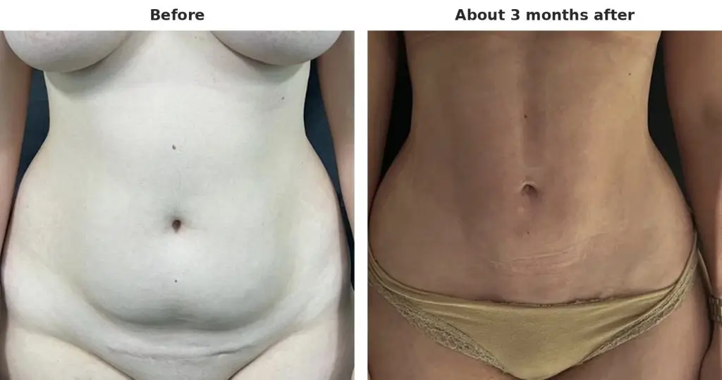 Case 1: tummy, front view, before and about 3 months after liposuction with Argo Plasma skin tightening