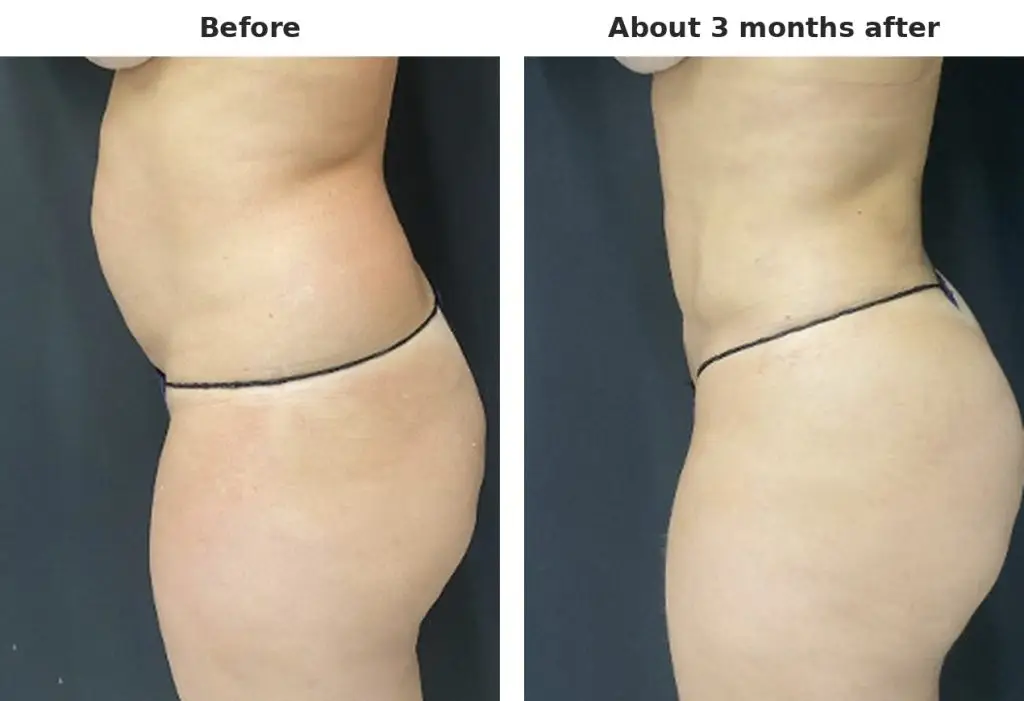 Case 2: tummy and waist, side view, before and about 3 months after liposuction with Argo Plasma skin tightening