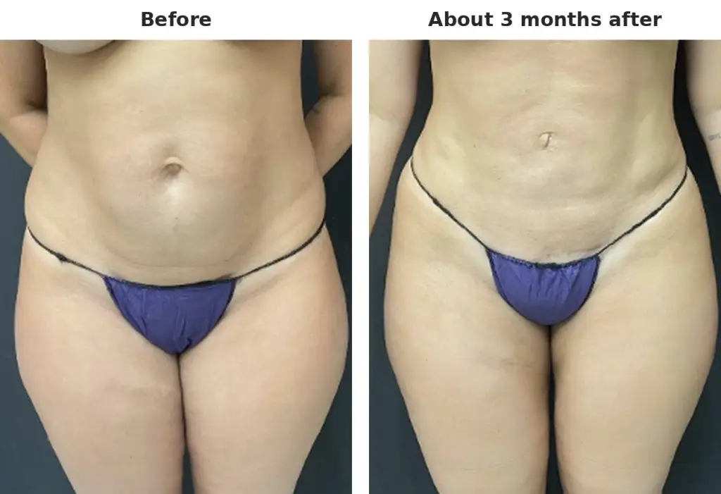 Case 3: tummy, waist and thighs, front view, before and about 3 months after liposuction with Argo Plasma skin tightening