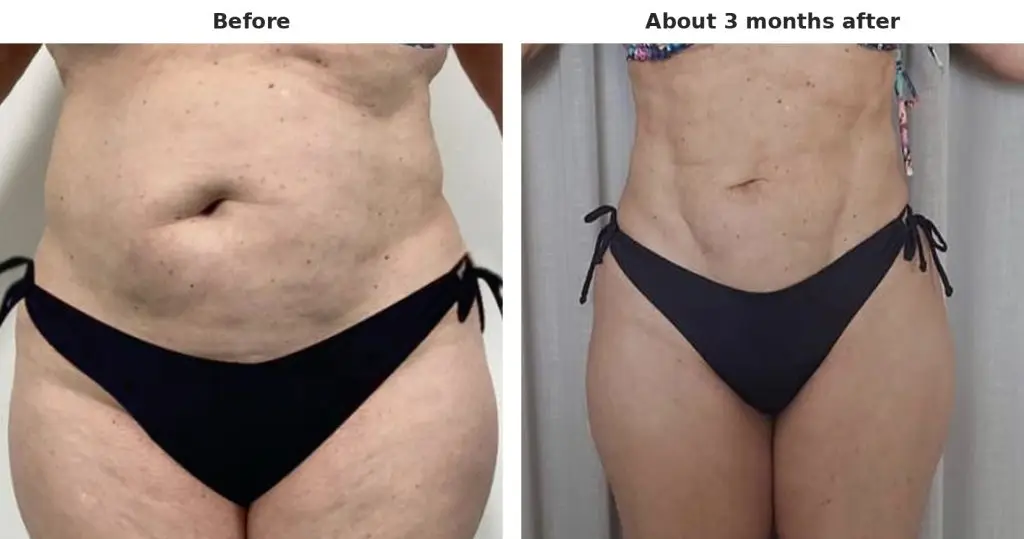 Case 4: tummy and waist, front view, before and about 3 months after liposuction with Argo Plasma skin tightening