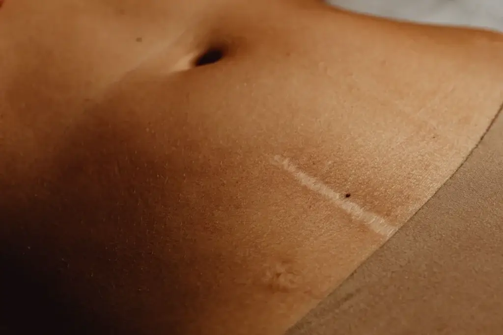 A surgical scar on the lower abdomen